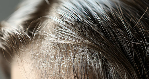 Alternatives to Ciclopirox shampoos. Exploring safe and effective options