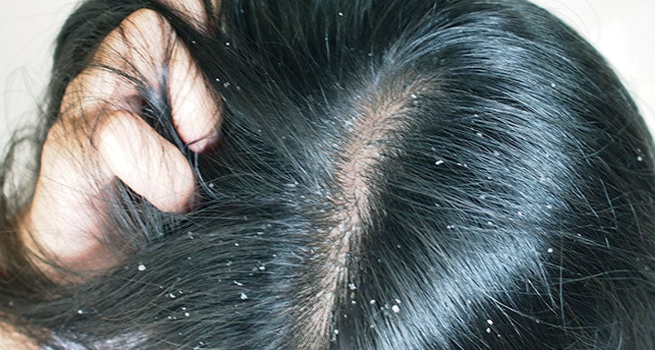 Coal Tar Shampoo Side Effects & Sensitive Scalp Care Solutions